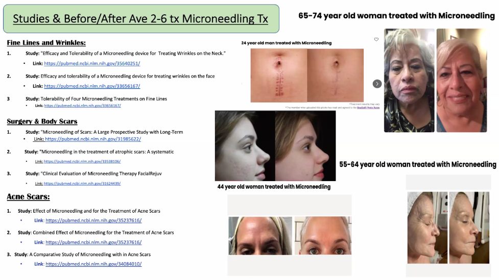 microneedling acupuncture